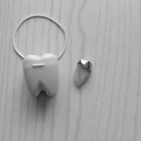 40代初めての抜歯：抜歯の痛みと抜歯後の腫れ
