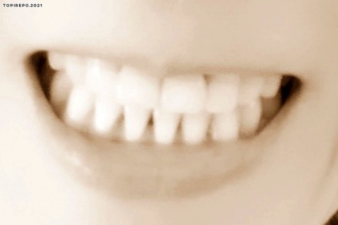 40代 歯列矯正 終了後の歯並び